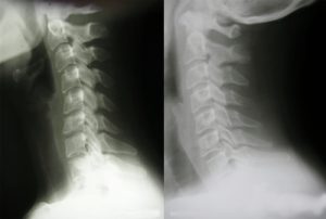 ストレートネック